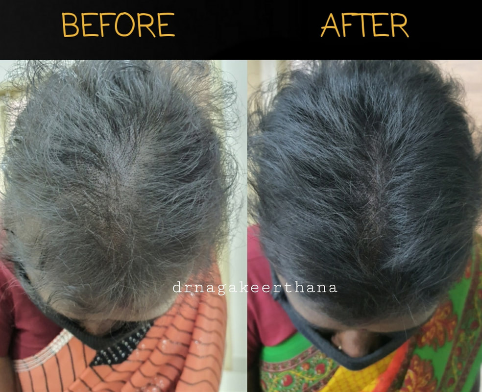 Hair Fall Loss Treatment in kumbakonam
