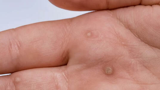 Types of Warts and How to Treat Them  A Visual Guide  Allure